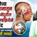 तरूणीच्या नाक-कानातून वाहणारे मेंदूतील पाणी शस्त्रक्रियेने बंद